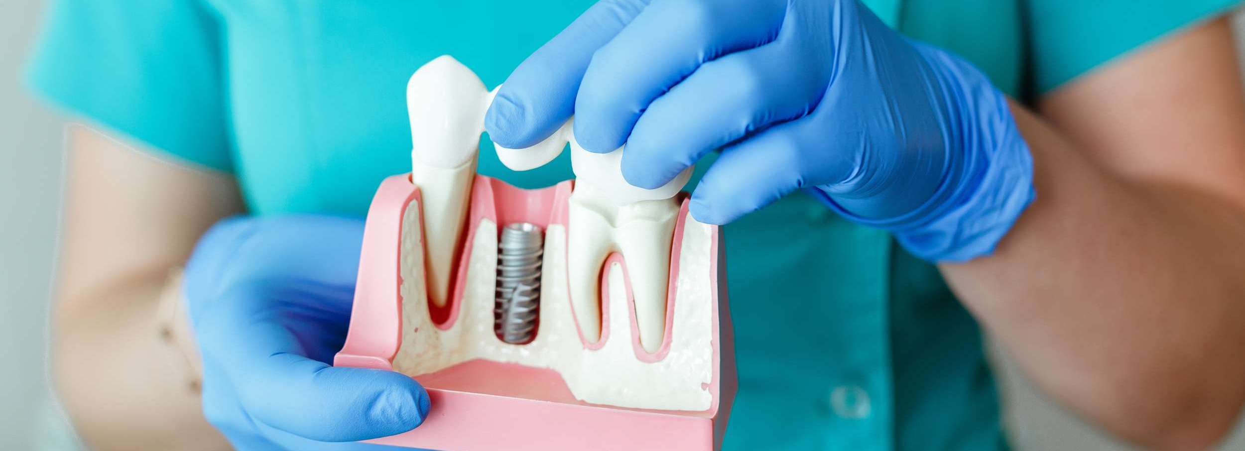 Dental Implants