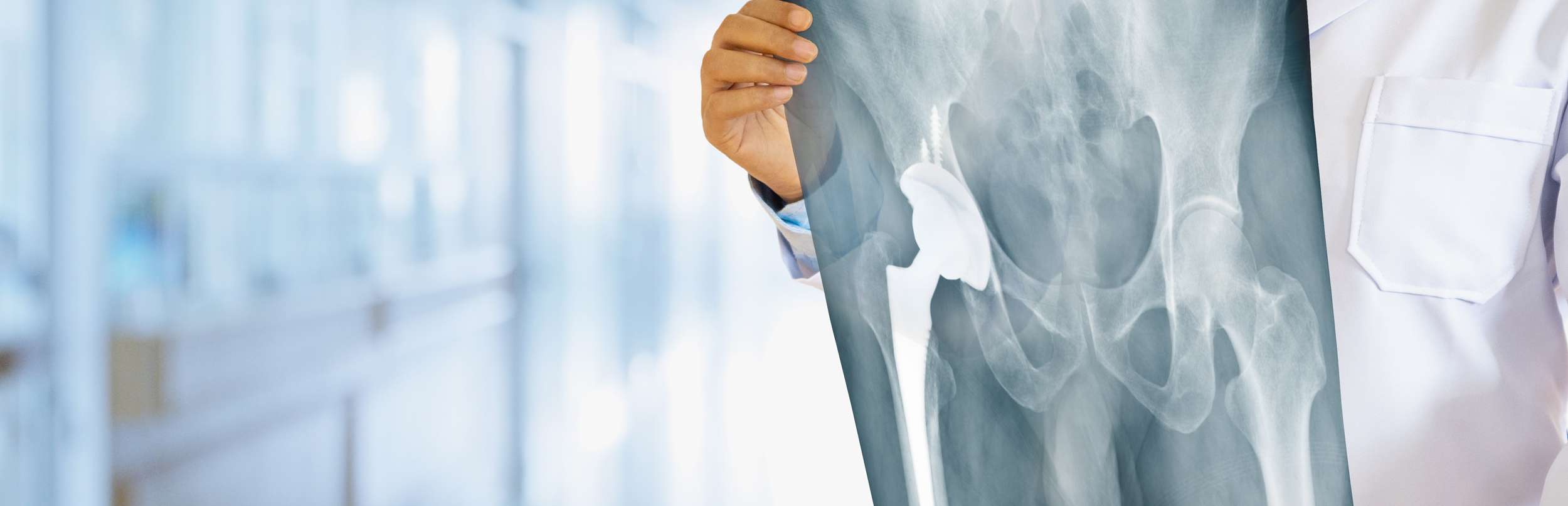 Doctor looking at hip replacement xray