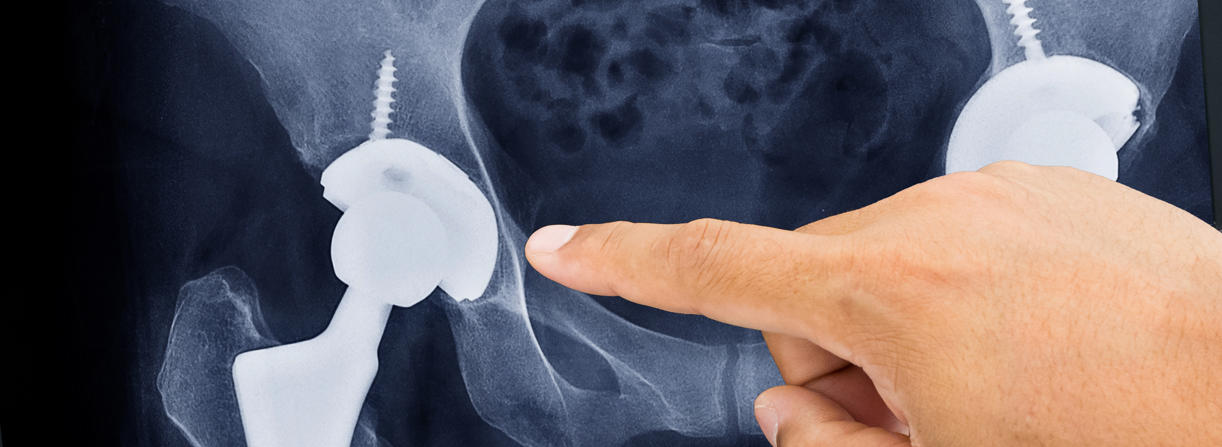 hand pointing at hip replacement