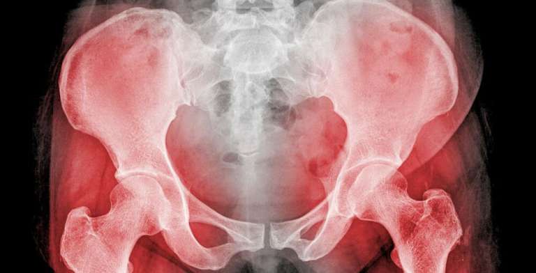 Hip replacement claims