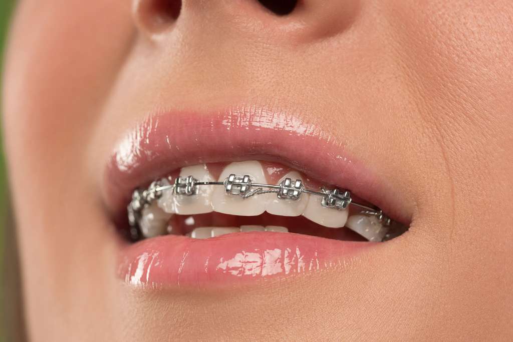 woman with teeth braces