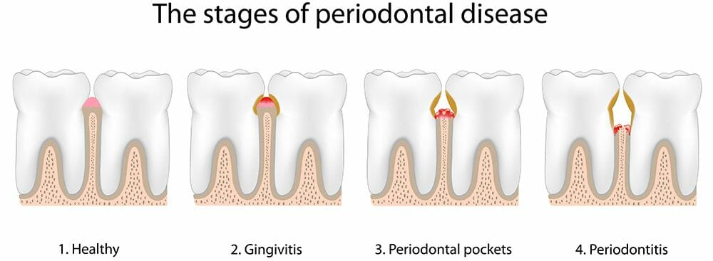 Periodontal disease (Gum disease)