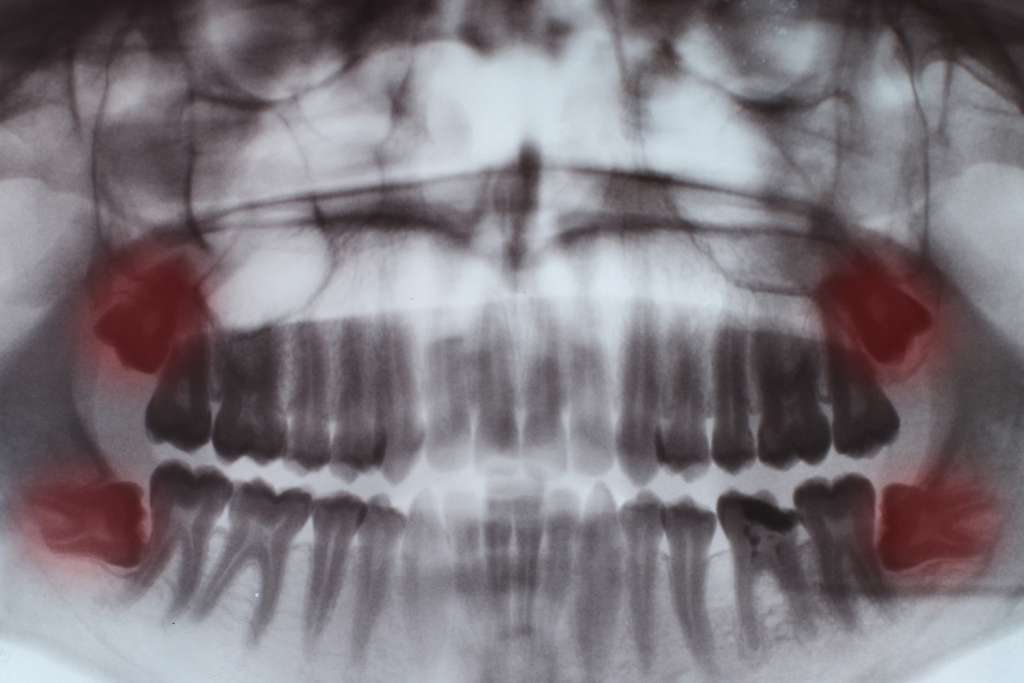 Wisdom Tooth x-ray