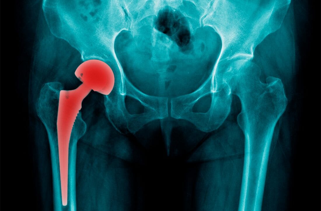 Hip Replacement Prosthesis Show in X-Ray