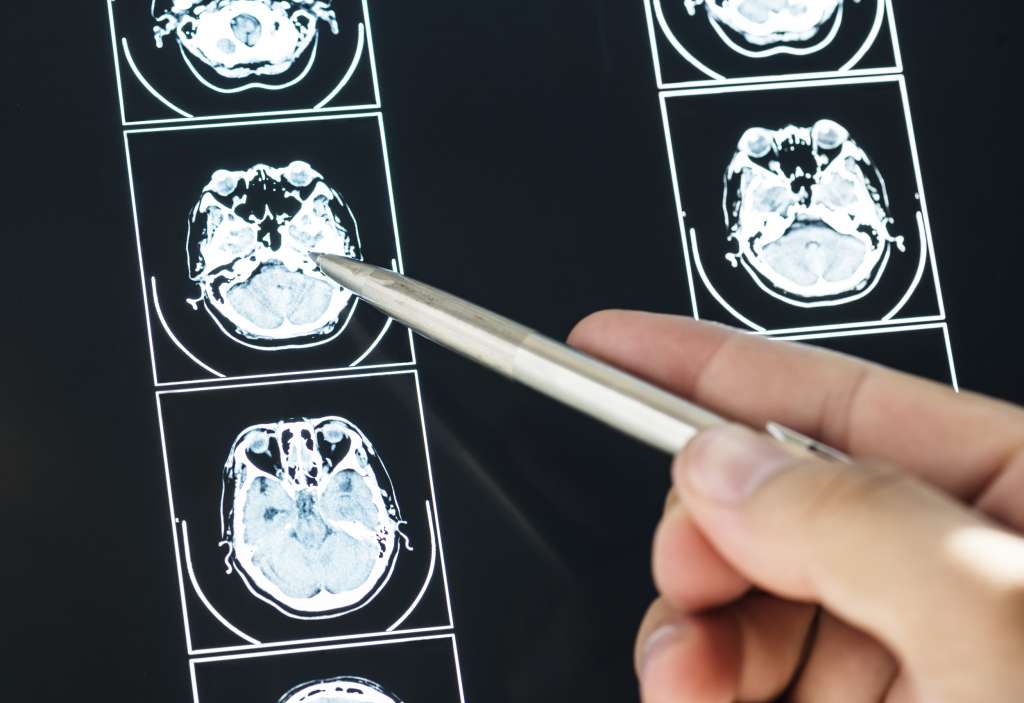 closeup of brain mri scan result