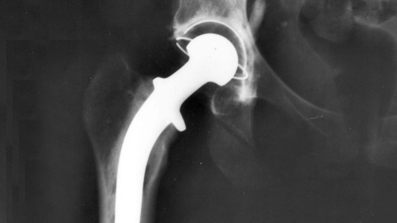 Prosthetic hip X-Ray
