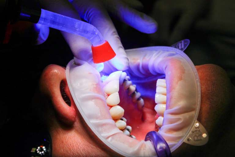 A Dentist checks teeth under UV light