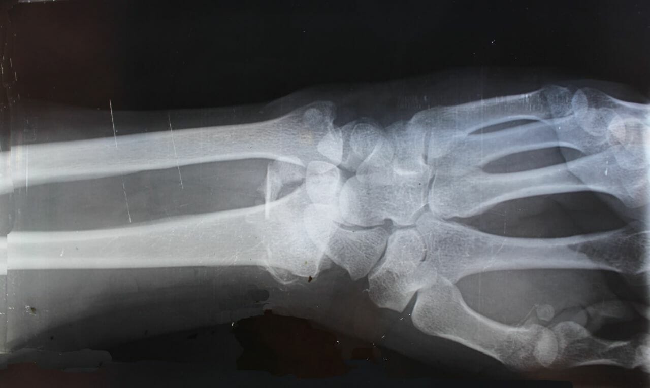 An x-ray of the wrist, like what would be taken to diagnose a scaphoid fracture.