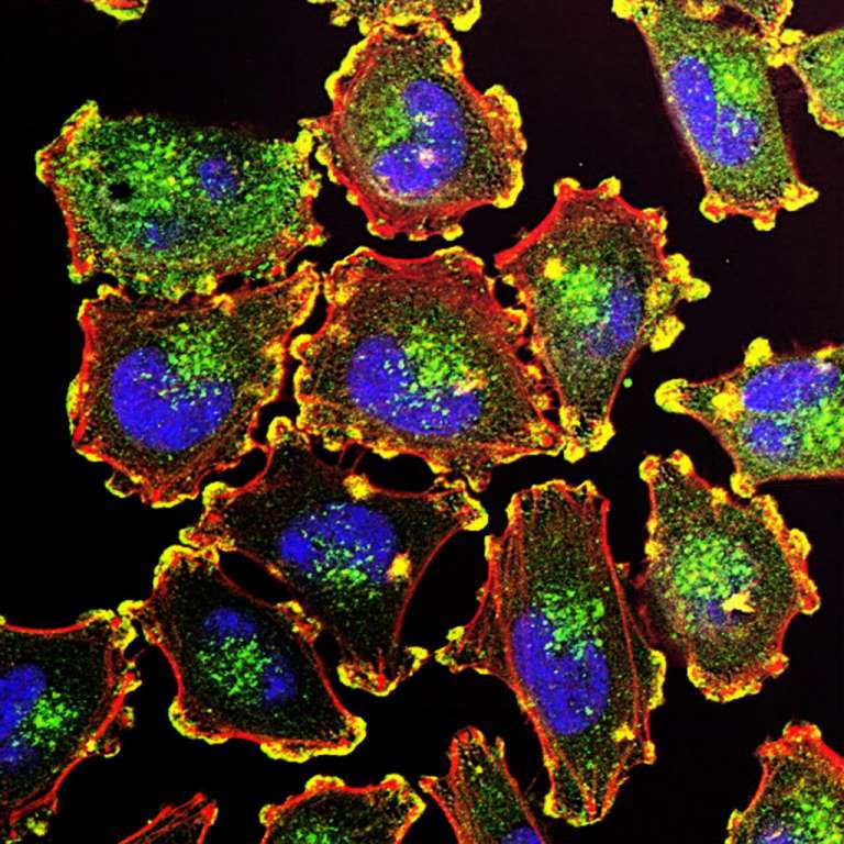 Metastatic Melanoma Cells - a type of cancer cell