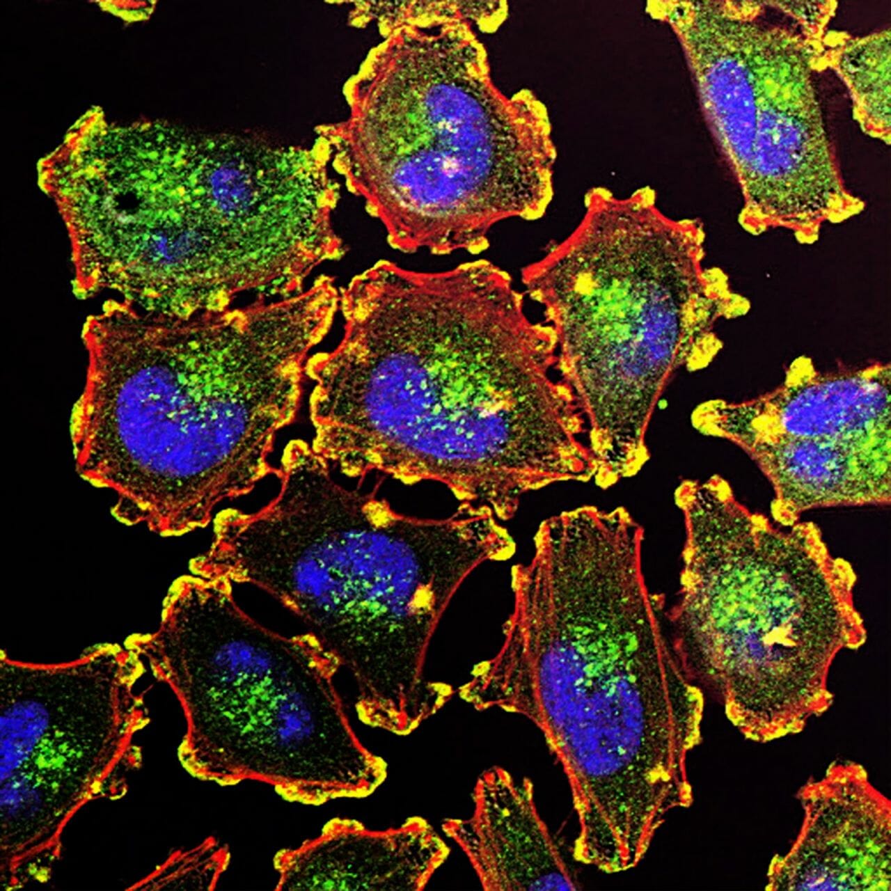 Metastatic Melanoma Cells - a type of cancer cell